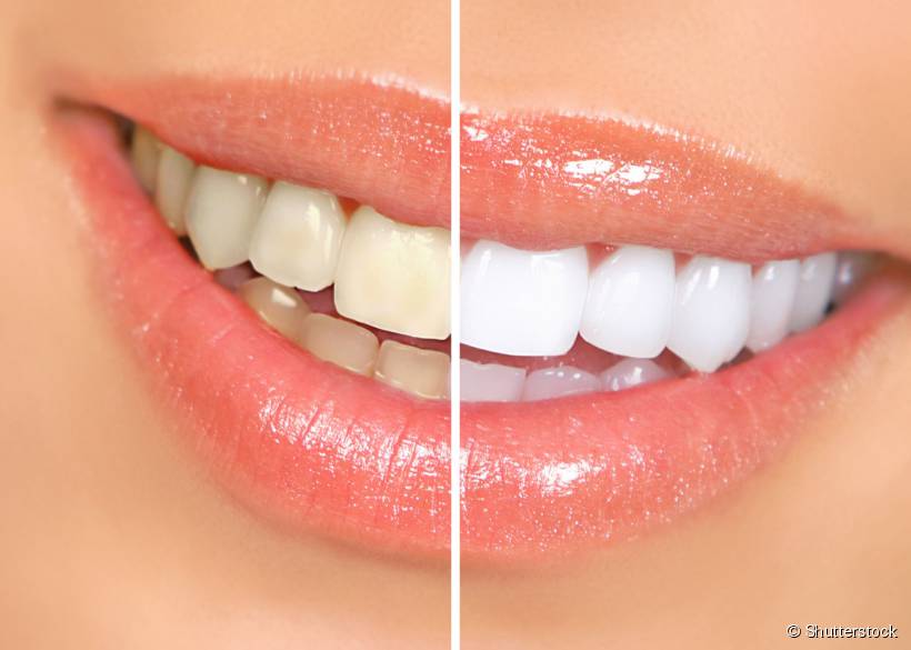 Com as lentes de contato dental, o sorriso fica mais iluminado
